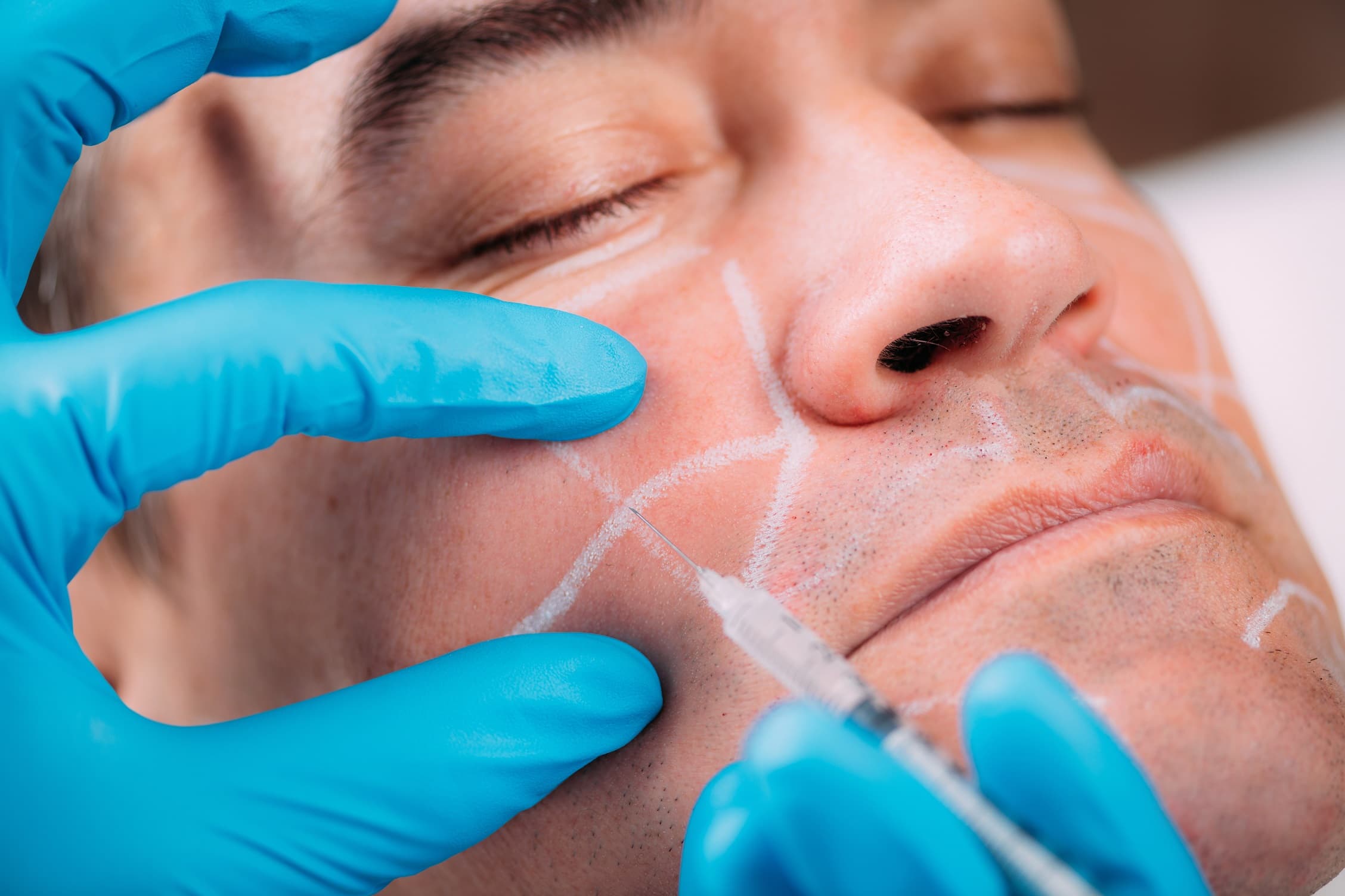 Dermal filler injections for men. Middle-aged man receives dermal filler injection for reducing nasolabial

folds and wrinkles.