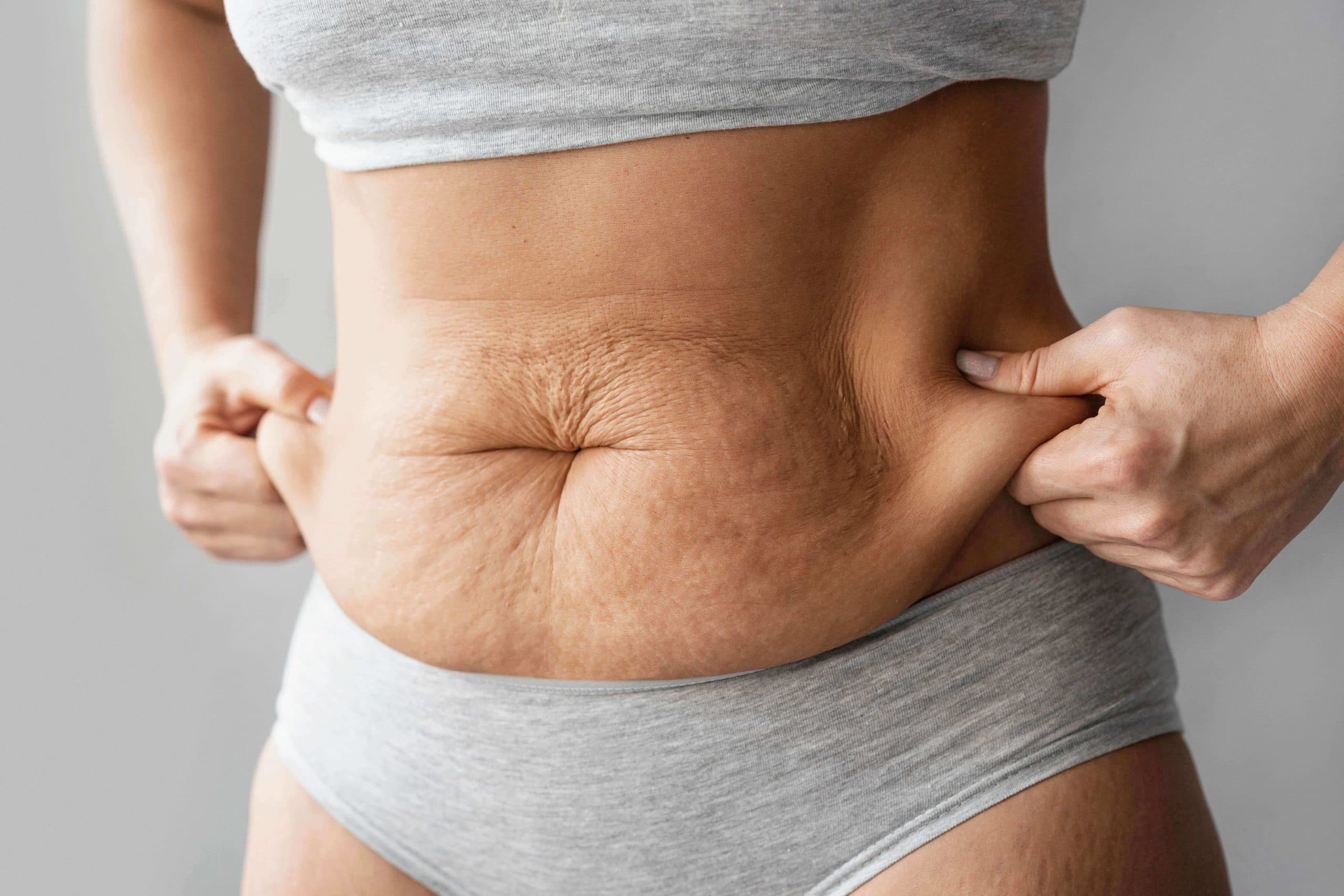 cirugia mommy makeover en Málaga para eliminar la flacidez y pariencia abultada de la modelo que sostiene la piel sobrante de su abdomen