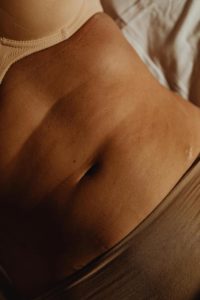 ¿Cómo se arregla la diastasis abdominal?