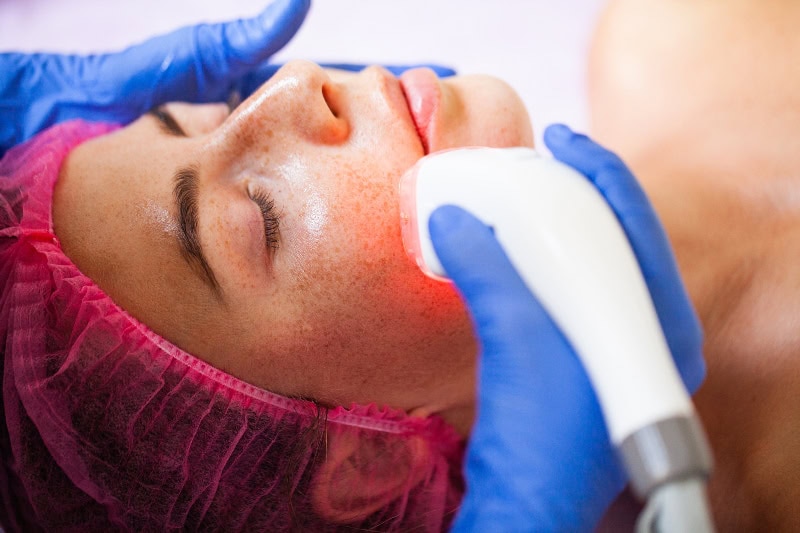 rejuvenecimiento facial con láser