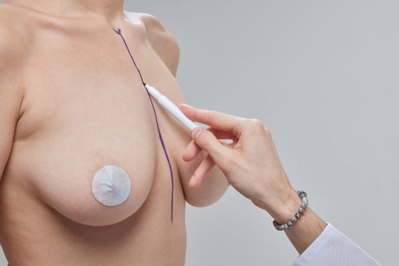 corrección de implantes mamarios