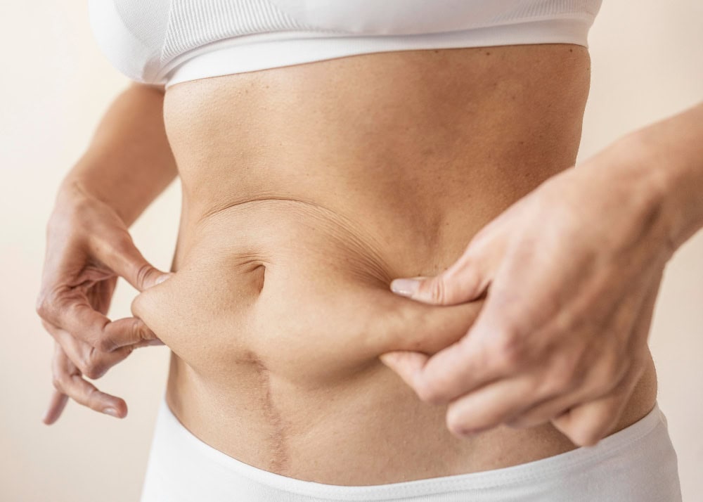 diastasis de rectos abdominales