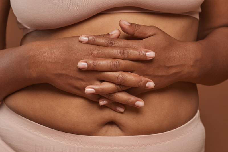 diastasis severa