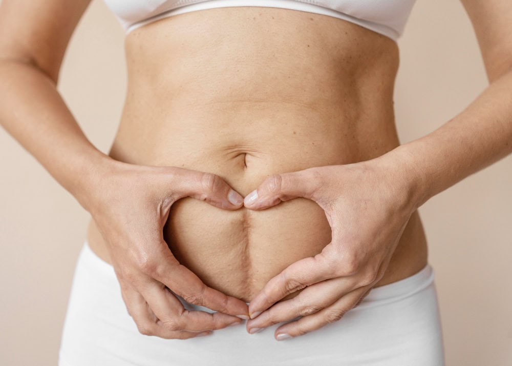 cicatriz operacion diastasis abdominal