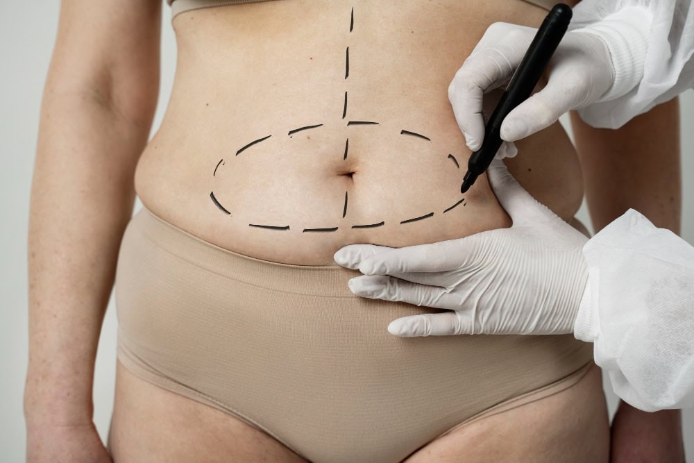 abdominoplastia en T