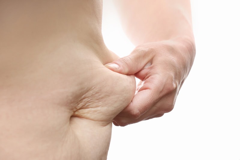 piel sobrante despues de adelgazar cirugia