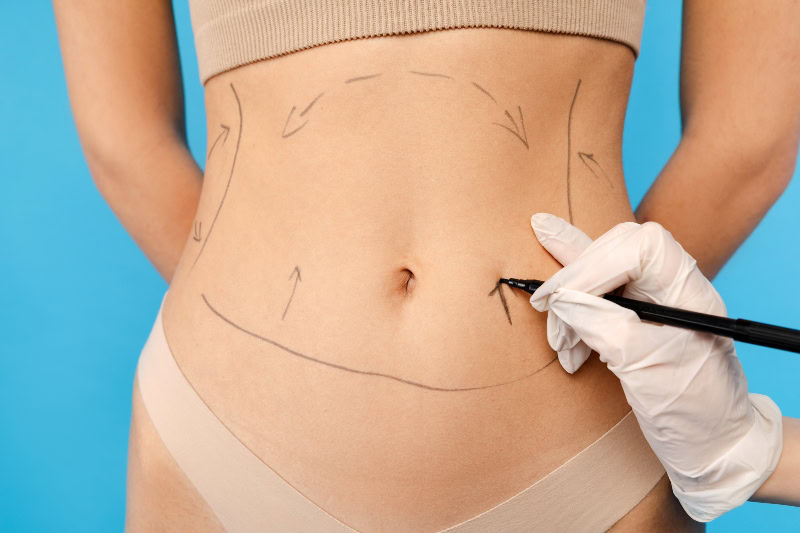 operaciones de barriga